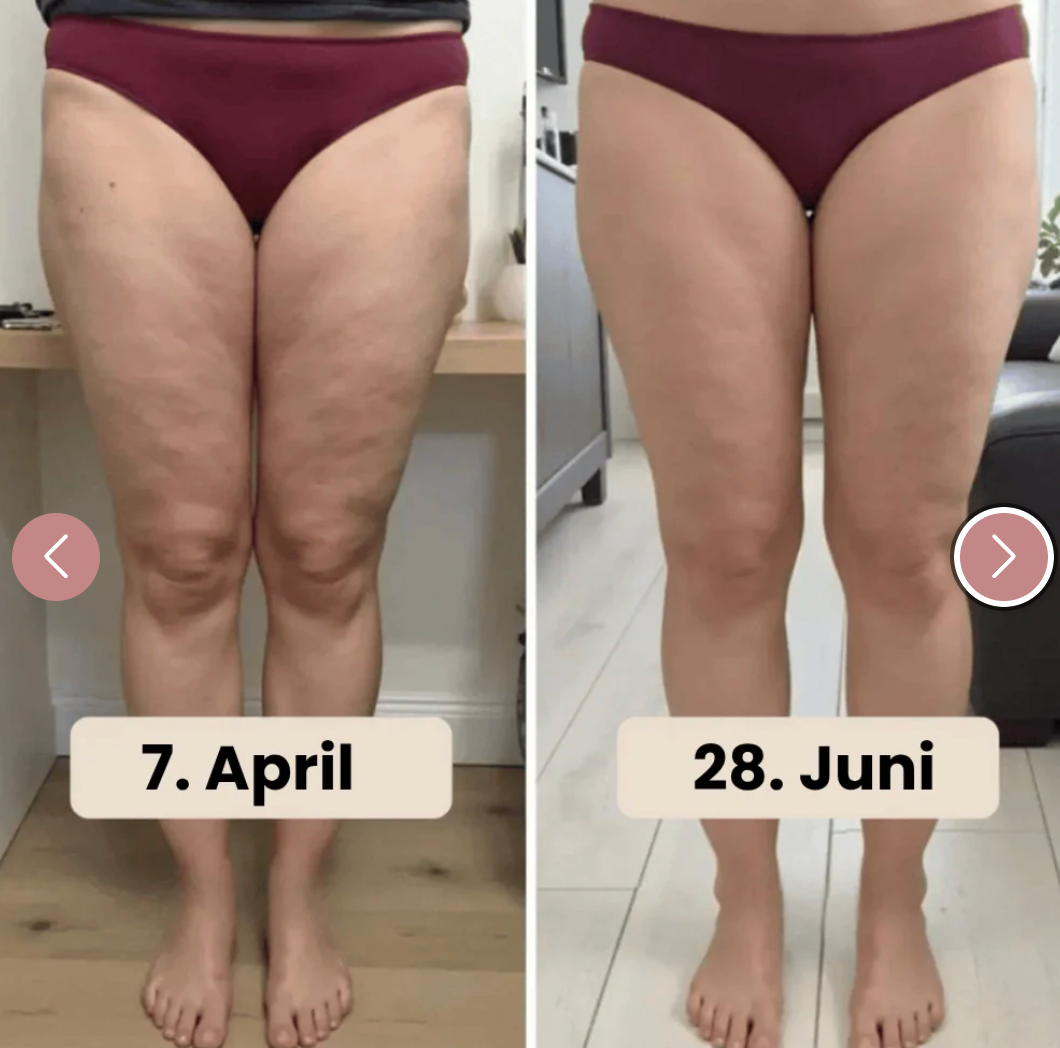 CelluFit® - Anti-Cellulite Leggins