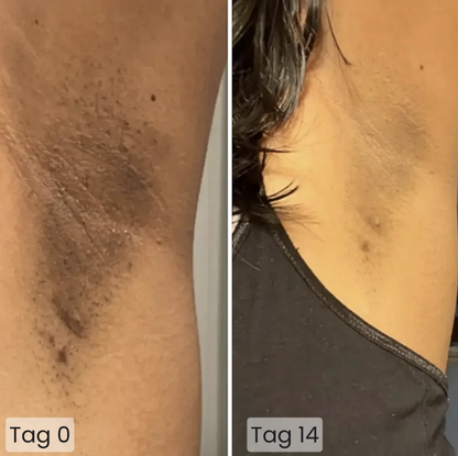 Vorher-Nachher-Bild einer Achsel: links dunkle Verfärbungen und eingewachsene Haare, rechts nach 14 Tagen sichtbar aufgehellte und glattere Haut.