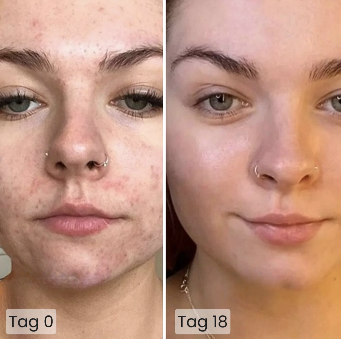Vorher-Nachher-Bild einer Frau mit Akne: links Tag 0 mit deutlich sichtbaren Hautunreinheiten, rechts Tag 18 mit klarer, deutlich verbesserter Haut.
