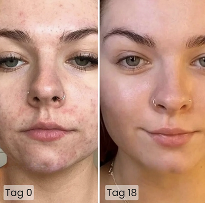 Vorher-Nachher-Bild einer Frau mit Akne: links Tag 0 mit deutlich sichtbaren Hautunreinheiten, rechts Tag 18 mit klarer, deutlich verbesserter Haut.