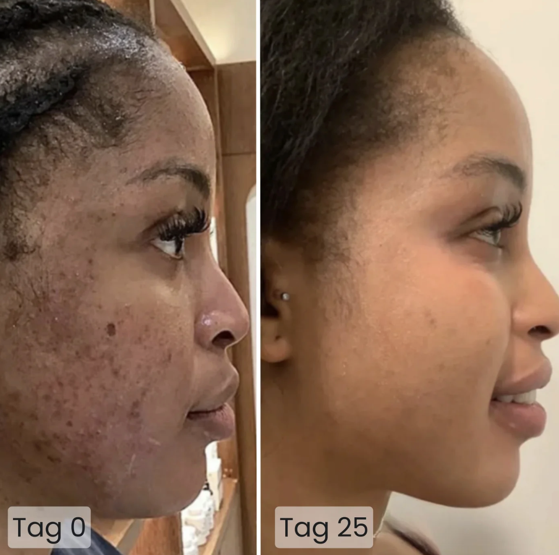 Seitlicher Vergleich einer Frau mit Akne: links an Tag 0 starke Hautunreinheiten, rechts nach 25 Tagen glatte, ebenmäßige Haut.