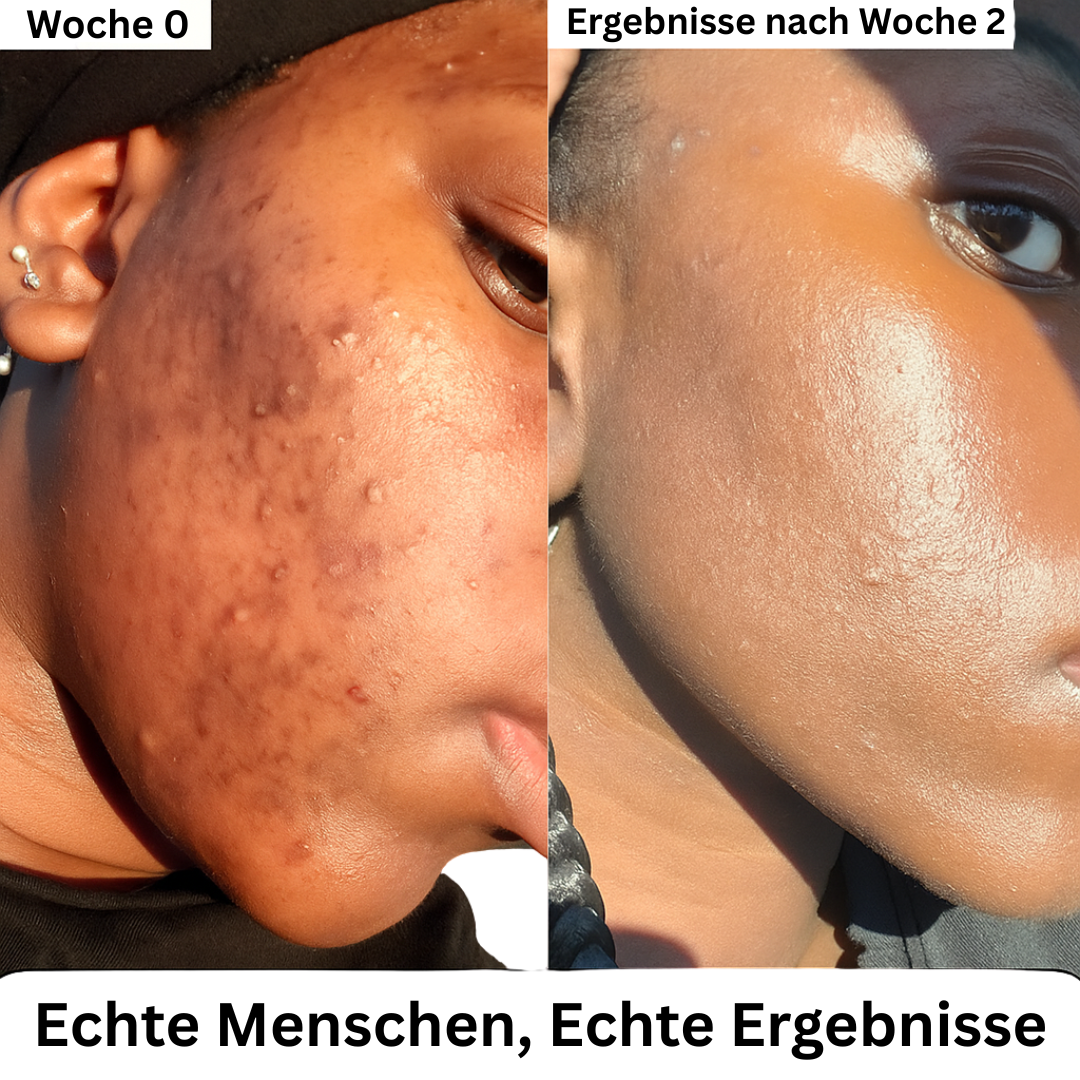 Nahaufnahme einer Frau mit dunkler Haut: links in Woche 0 starke Akne und Pickel, rechts nach zwei Wochen deutlich klarere, glatte Haut. Text unten: ‚Echte Menschen, echte Ergebnisse.